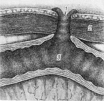 Свищи в кишечнике Свищи в кишечнике