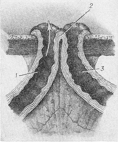 Свищи в кишечнике Свищи в кишечнике