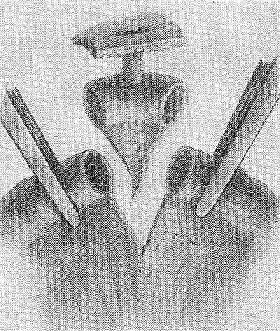 Свищи в кишечнике Свищи в кишечнике