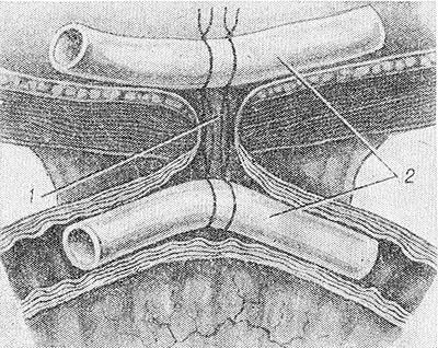 Свищи в кишечнике Свищи в кишечнике