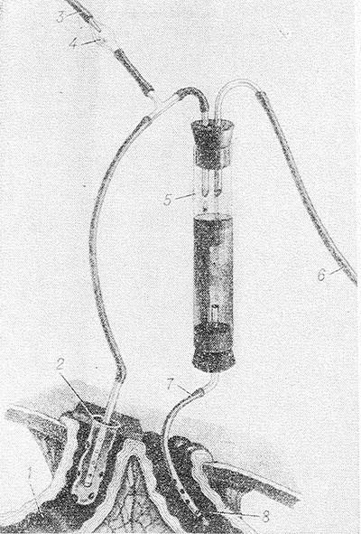Свищи в кишечнике Свищи в кишечнике