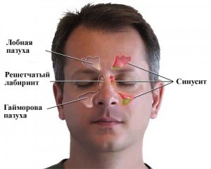 Киста гайморовой пазухи Киста гайморовой пазухи