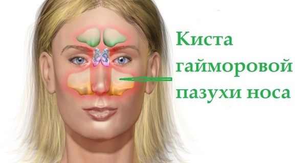 Киста гайморовой пазухи Киста гайморовой пазухи