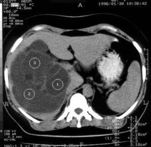 Что такое киста в печени и чем она опасна: симптомы и лечение Что такое киста в печени и чем она опасна: симптомы и лечение