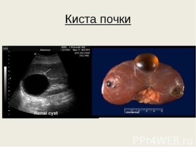 Какие симптомы свидетельствуют об образовании кисты на почке Какие симптомы свидетельствуют об образовании кисты на почке