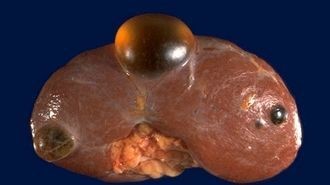 Множественные кисты почек: как избавиться от заболевания, методы терапии Множественные кисты почек: как избавиться от заболевания, методы терапии