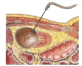 Лечение синусовой кисты левой почки Лечение синусовой кисты левой почки