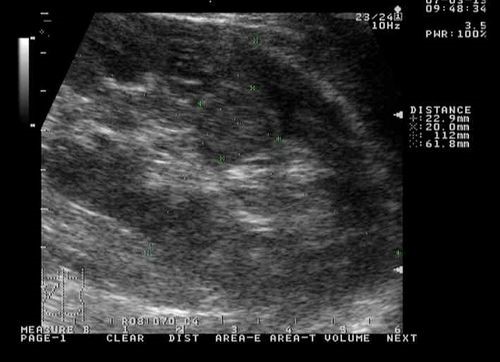 Лечение синусовой кисты левой почки Лечение синусовой кисты левой почки