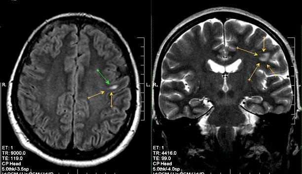 Глиоз головного мозга, очаги сосудистого генеза и иного Глиоз головного мозга, очаги сосудистого генеза и иного