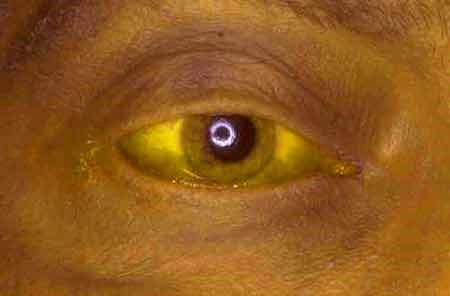 Классификация и виды желтух: таблица и описание Классификация и виды желтух: таблица и описание