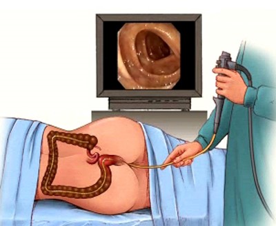 Колоноскопия Колоноскопия