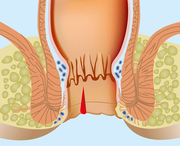 Почему возникает кровь из прямой кишки? Почему возникает кровь из прямой кишки?