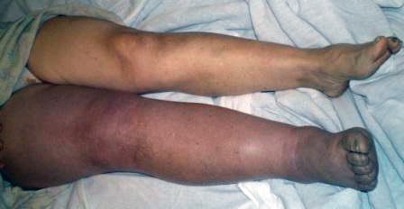 Особенности забора крови на сахар для получения точных результатов Особенности забора крови на сахар для получения точных результатов