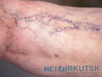 Особенности забора крови на сахар для получения точных результатов Особенности забора крови на сахар для получения точных результатов