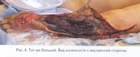 Особенности забора крови на сахар для получения точных результатов Особенности забора крови на сахар для получения точных результатов