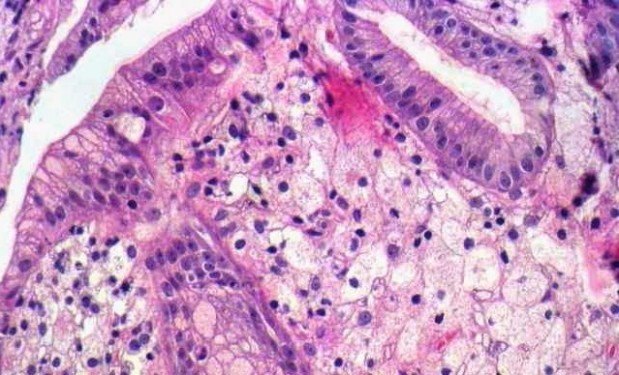 Что такое ксантома желудка? Что такое ксантома желудка?