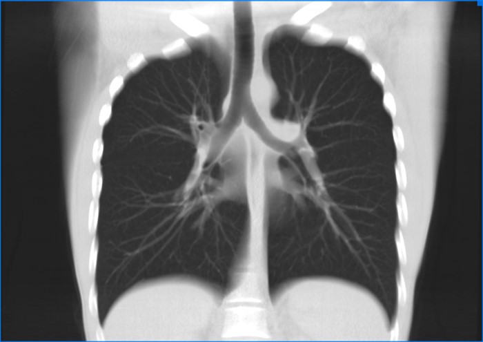 Особенности компьютерной томографии легких Особенности компьютерной томографии легких