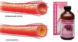 Атеросклероз сосудов мозга и его симптомы Атеросклероз сосудов мозга и его симптомы