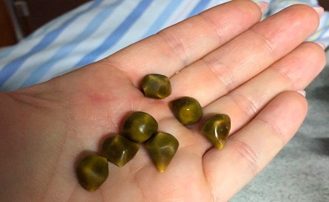 Способы дробления камней в желчном пузыре Способы дробления камней в желчном пузыре