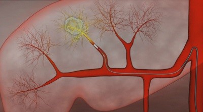 Лечение метастаз печени Лечение метастаз печени
