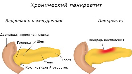 Обострение воспаления поджелудочной железы Обострение воспаления поджелудочной железы