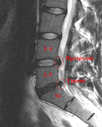 Диффузная протрузия диска l4 l5 Диффузная протрузия диска l4 l5