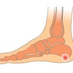 Пяточная шпора лечение димексидом Пяточная шпора лечение димексидом