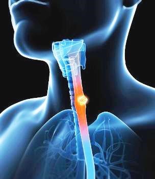 Методы лечения рака гортани Методы лечения рака гортани