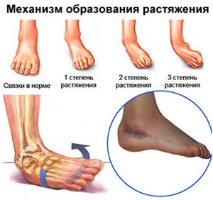 Связки голеностопного сустава Связки голеностопного сустава