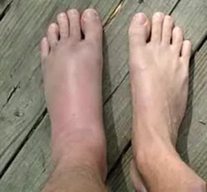 Связки голеностопного сустава Связки голеностопного сустава