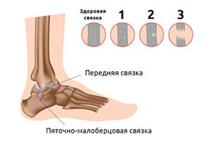 Связки голеностопного сустава Связки голеностопного сустава
