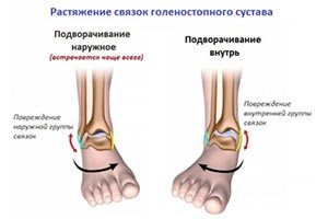 Связки голеностопного сустава Связки голеностопного сустава