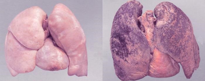 Легкие курящего человека Легкие курящего человека