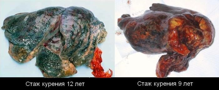Легкие курящего человека Легкие курящего человека