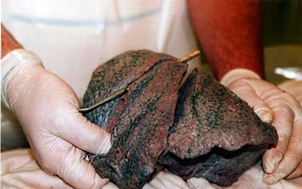 Легкие курящего человека Легкие курящего человека