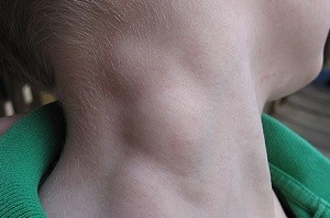 Почему возникает лимфома желудка и как ее лечить? Почему возникает лимфома желудка и как ее лечить?