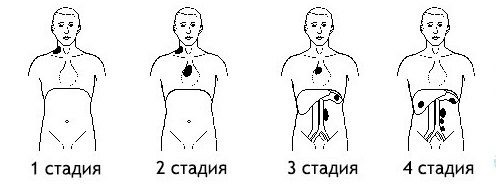 Почему возникает лимфома желудка и как ее лечить? Почему возникает лимфома желудка и как ее лечить?