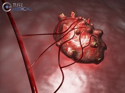 Метастазы в желудке Метастазы в желудке