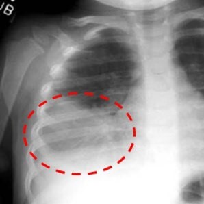 Микоплазменная пневмония Микоплазменная пневмония
