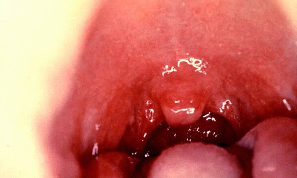 Ангина и температура: возможно ли одно без другого? Ангина и температура: возможно ли одно без другого?