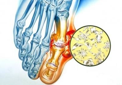 Как ответить на вопрос можно ли пить водку при подагре Как ответить на вопрос можно ли пить водку при подагре