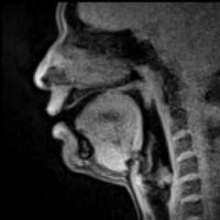 КТ гортани человека КТ гортани человека