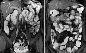 Для чего и как делается МРТ кишечника? Для чего и как делается МРТ кишечника?