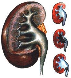 Нефролитиаз великий и ужасный Нефролитиаз великий и ужасный