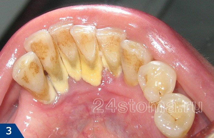 Устранение сильного запаха изо рта Устранение сильного запаха изо рта