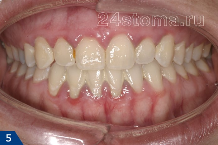 Устранение сильного запаха изо рта Устранение сильного запаха изо рта