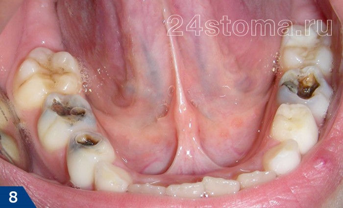 Устранение сильного запаха изо рта Устранение сильного запаха изо рта