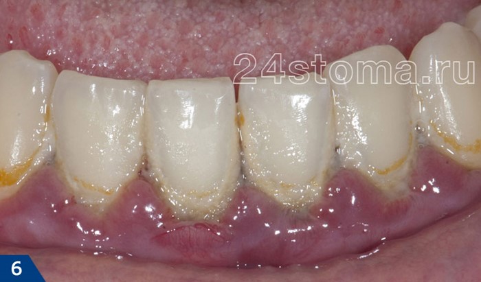 Устранение сильного запаха изо рта Устранение сильного запаха изо рта