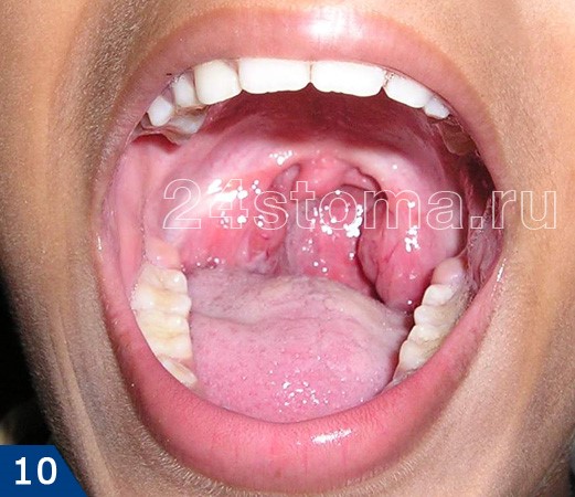 Устранение сильного запаха изо рта Устранение сильного запаха изо рта