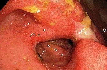 Симптомы и лечение язвы желудка в период обострения Симптомы и лечение язвы желудка в период обострения